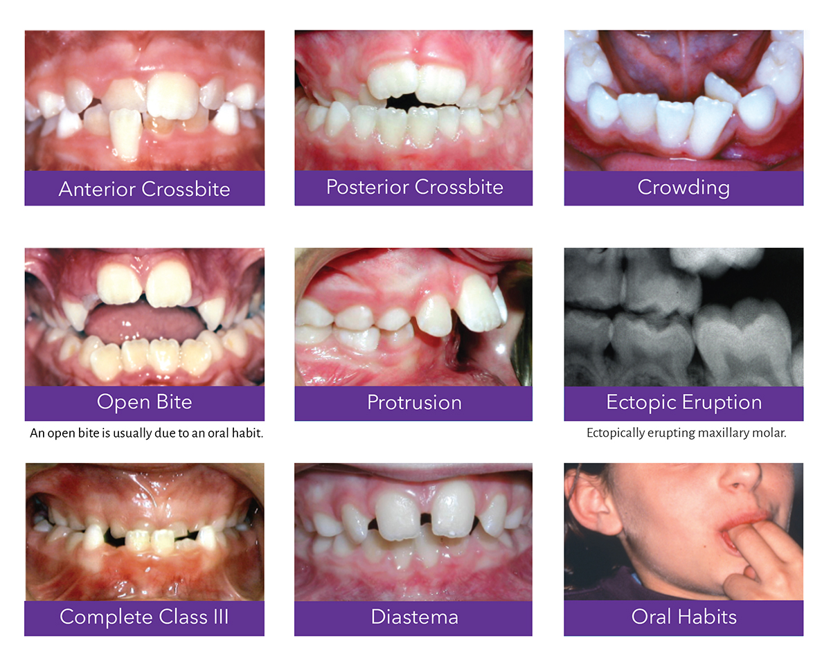 First Phase Treatment - PretoriaSmile Orthodontics
